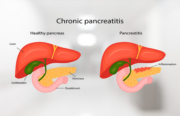 Acute and Chronic Pancreatitis