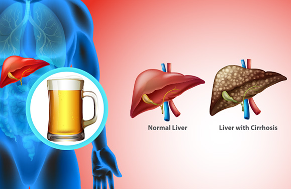 Alcoholic Liver Disease