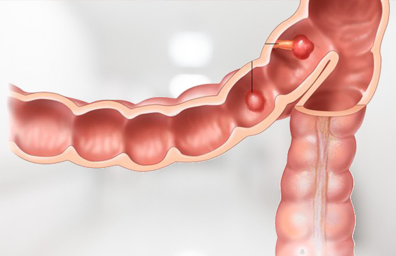 Colorectal Polyps