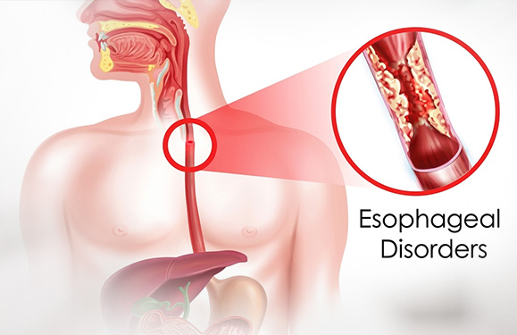 Esophageal Disorders