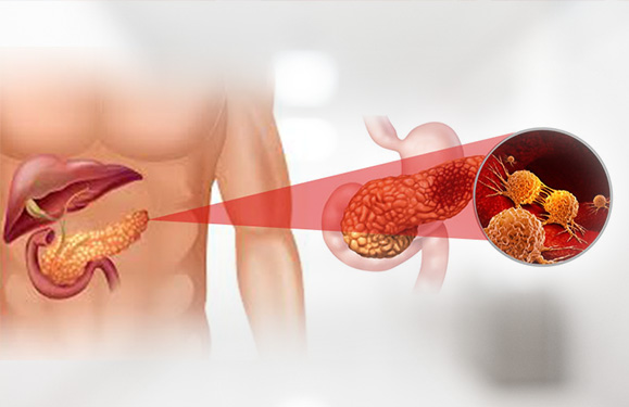 GI, Liver & Pancreatic Cancers