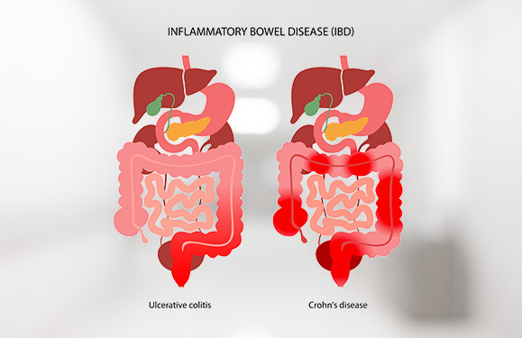 Inflammatory Bowel Disease (IBD)