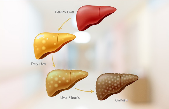 Liver Cirrhosis