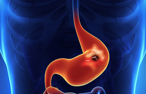 Upper GI Bleeding & Ulcers